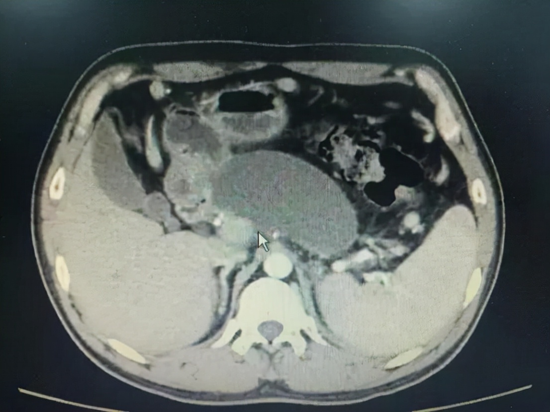 医生说是囊肿是什么意思,已经形成囊肿了怎么消除