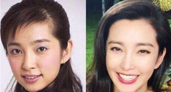 明星做烤瓷牙变凸嘴,明星烤瓷牙凸嘴