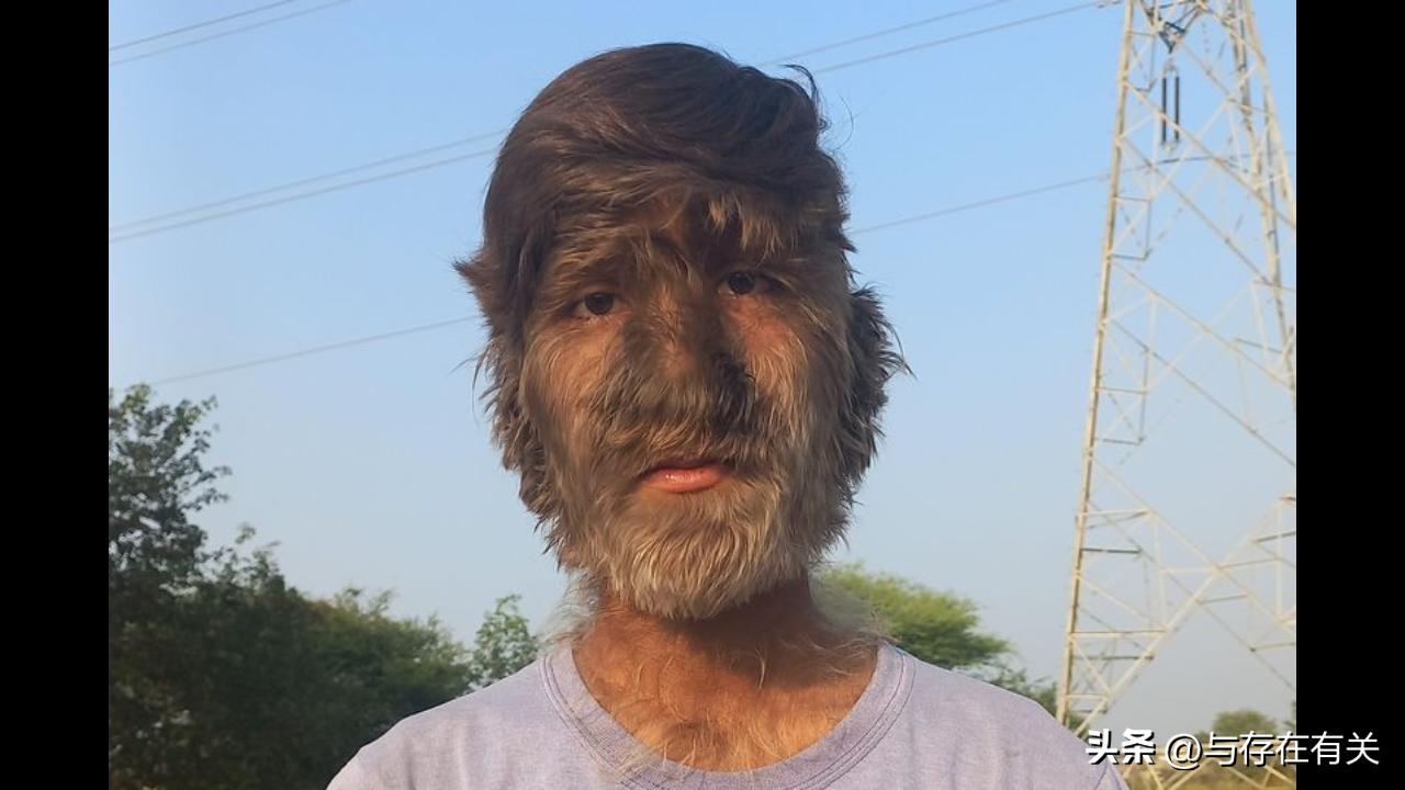 印度小伙患罕见疾病视频,印度8岁小孩长大后的奇闻异事