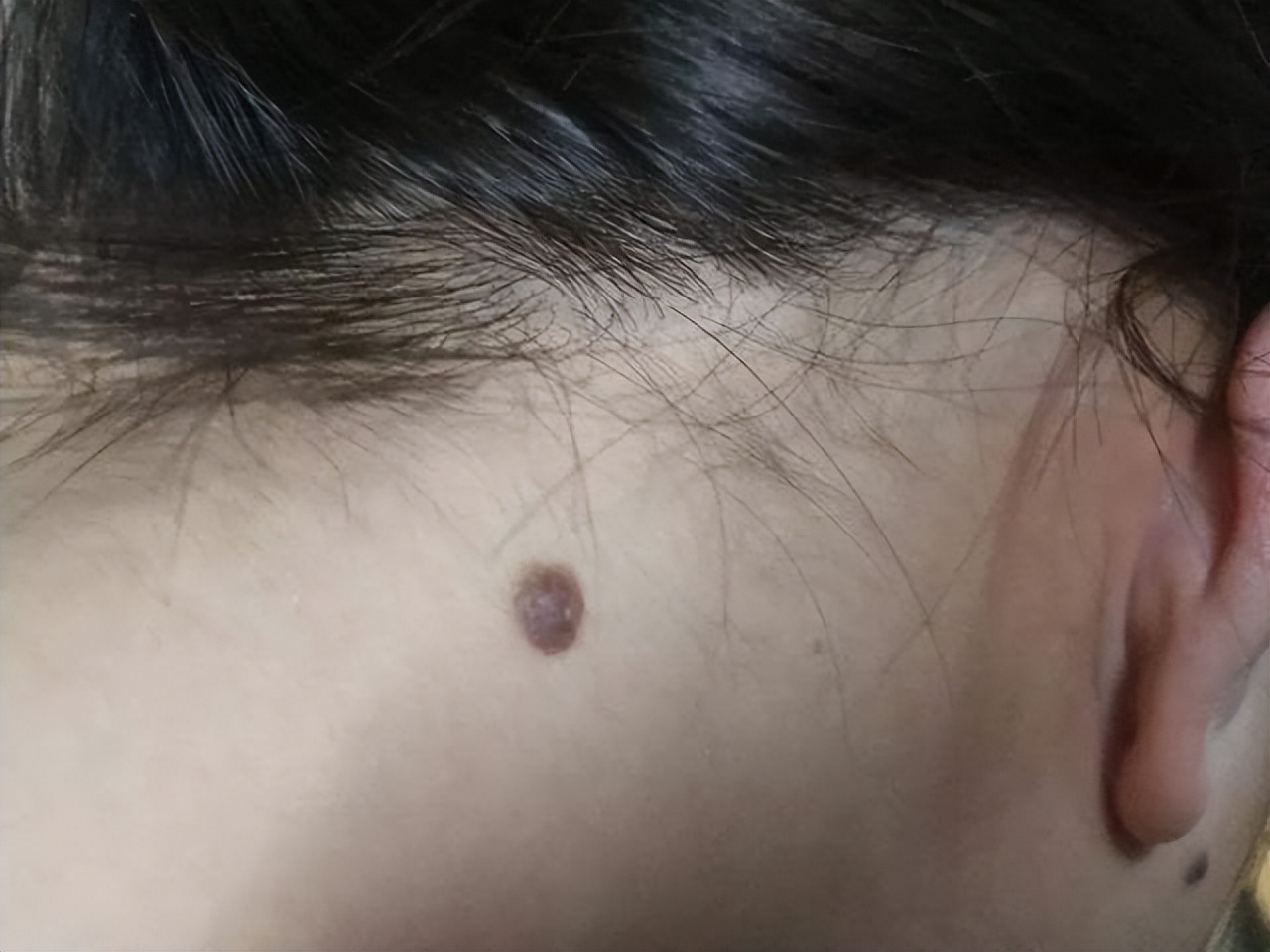 身体部位有黑痣和红痣是什么,痣黑如漆与深黑死痣区别