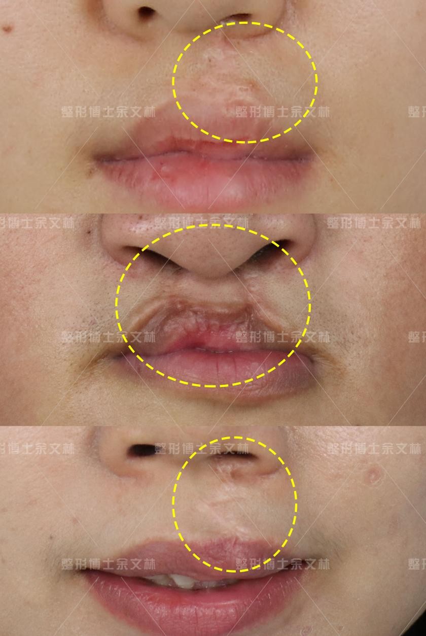 唇裂手术疤痕修复手术大概多少钱,唇裂手术后1个月后涂什么疤痕膏