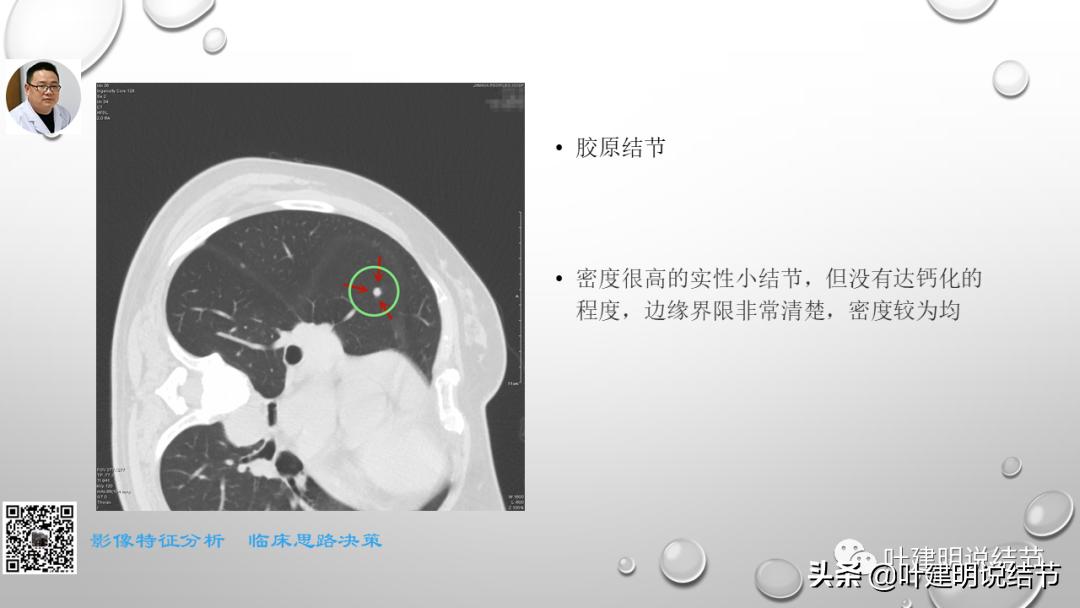 在《一脉阳光》呼吸影像诊断专题培训班上的讲课PPT（第一部分）