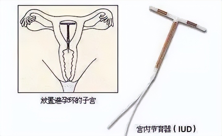 排卵期出血白带带血丝正常吗,白带带血褐色分泌物怎么办