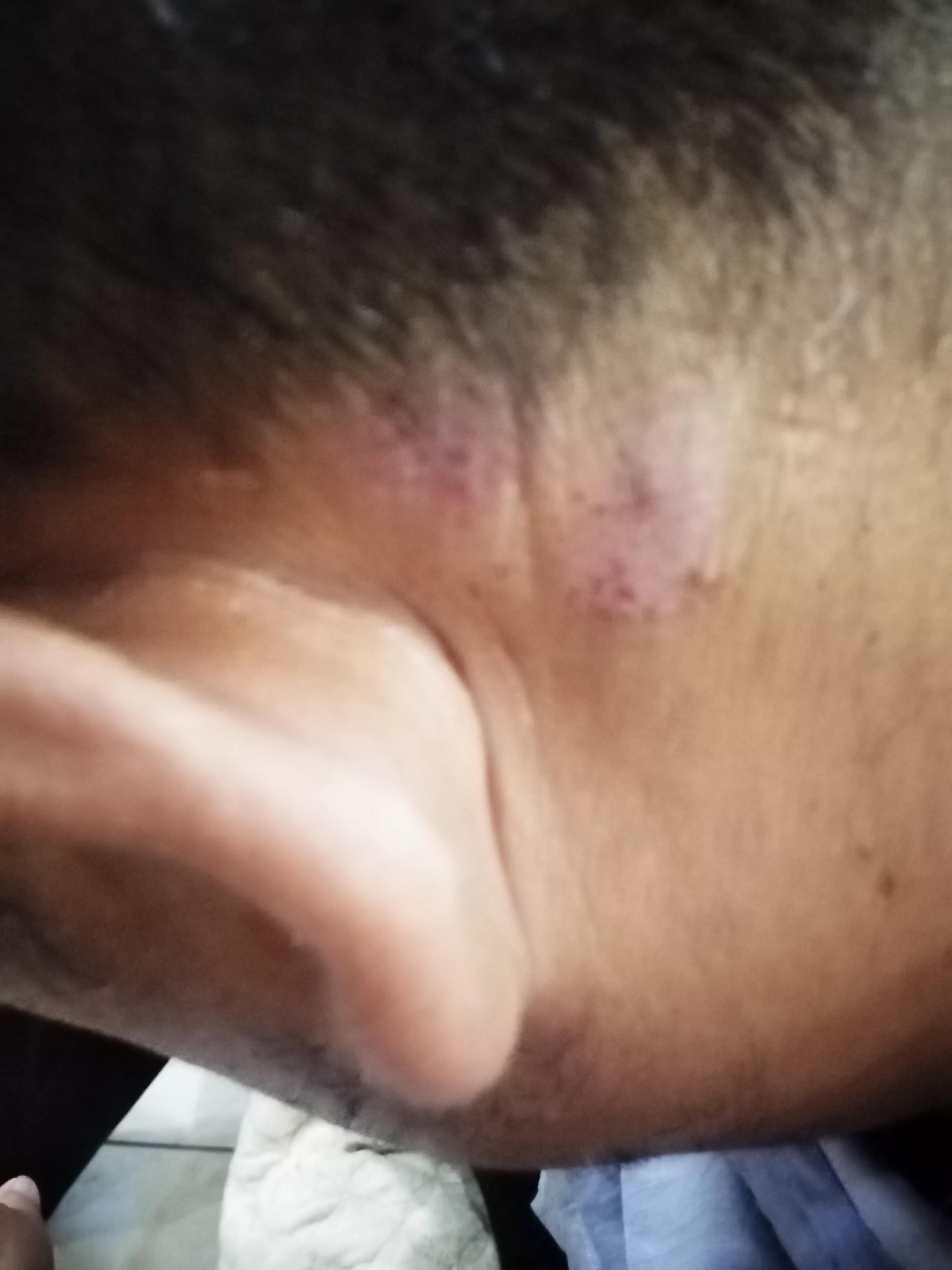 牛皮癣伴随一生是怎么样的体验,对抗牛皮癣一直在坚持