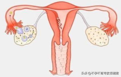 输卵管堵塞只能做试管吗？有没有别的办法？