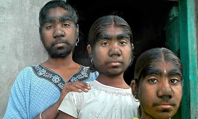 女生因为多毛症被歧视,身患多毛症