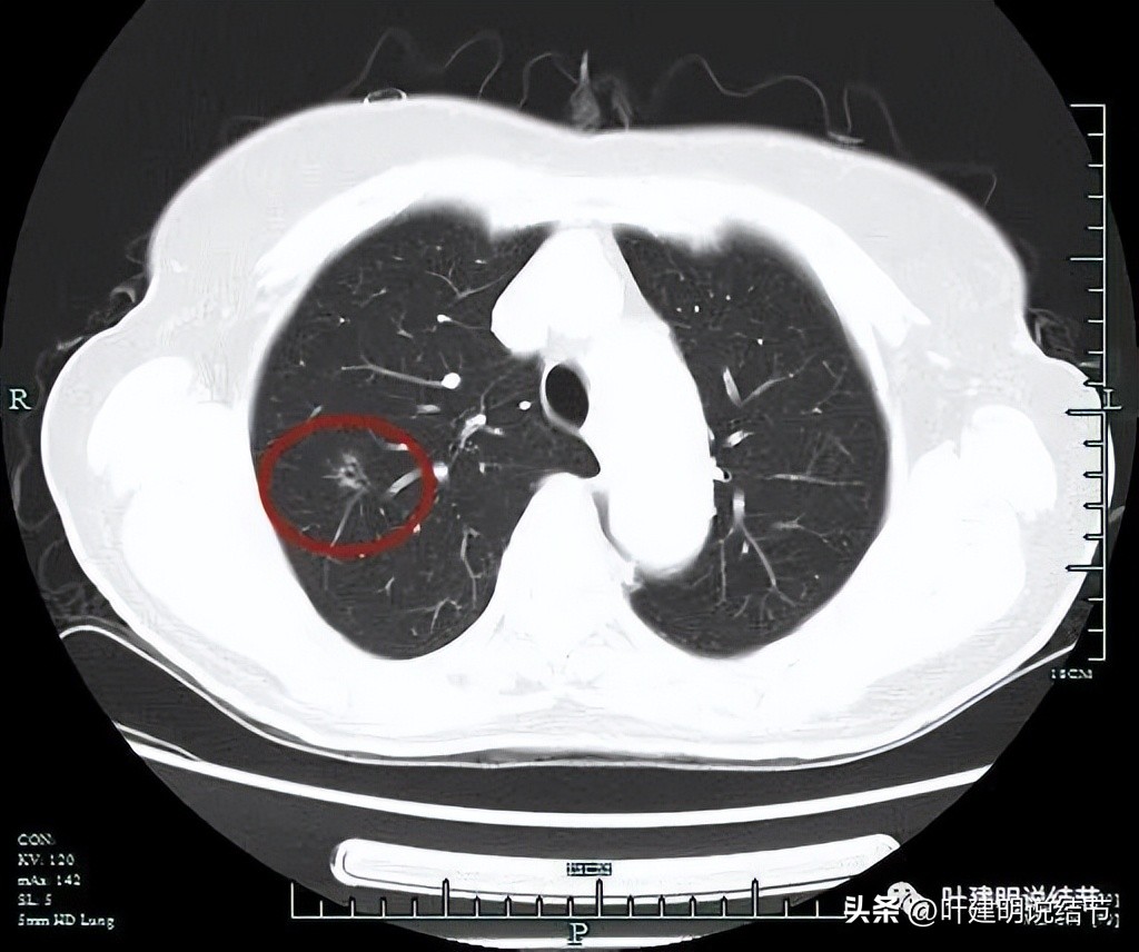 肺楔形切除肺功能降低,肺楔形切除需要缝合吗