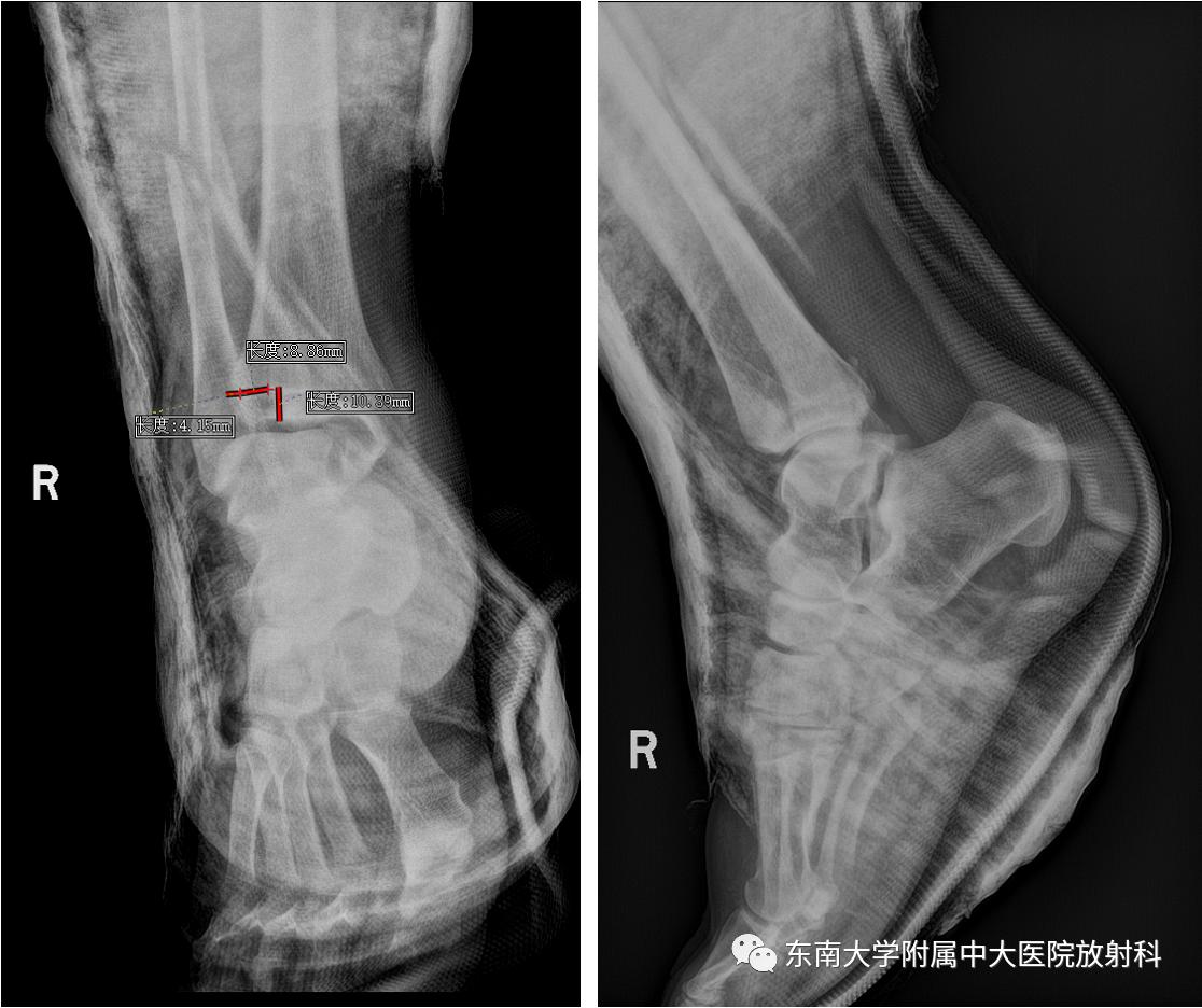 左腓骨下段骨折伴下胫腓联合分离,好文分享深度揭秘