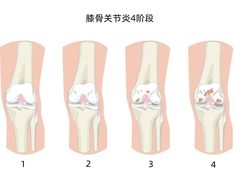 中年人膝盖退化怎么办,多大岁数膝盖开始退化