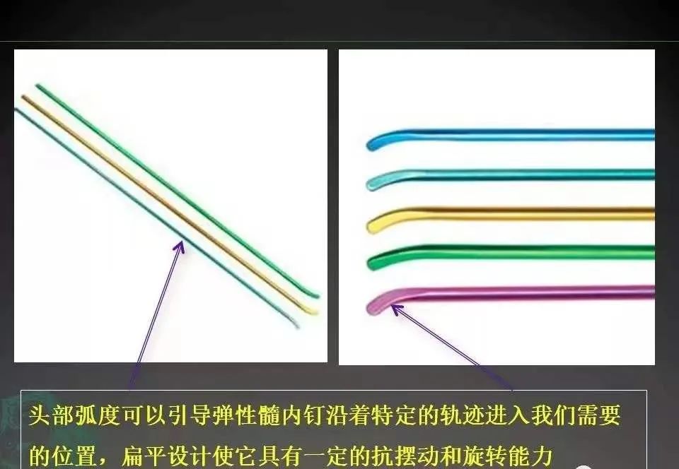 儿童股骨干骨折弹性髓内钉内固定,儿童股骨骨折打髓内钉