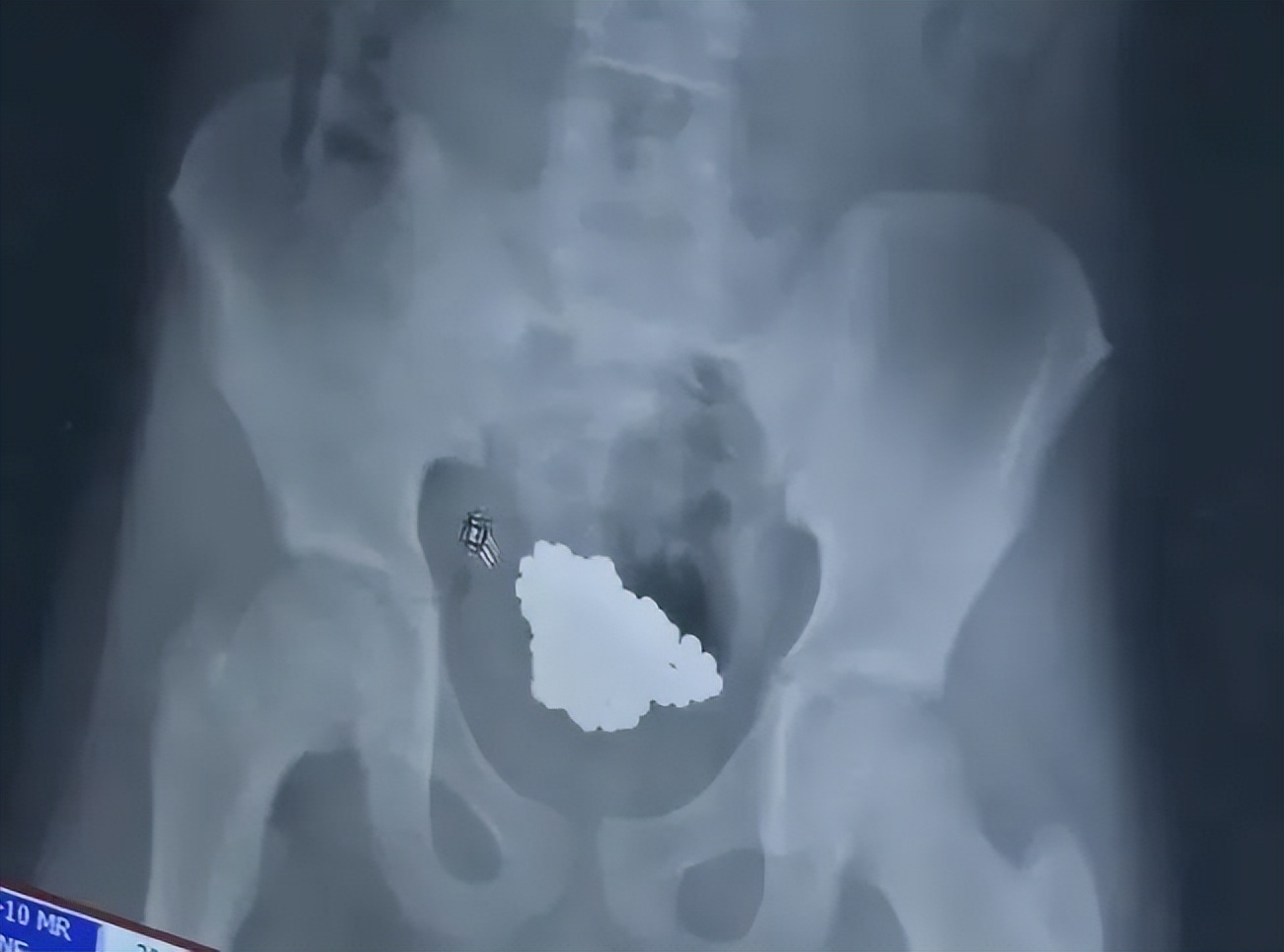 7岁女孩死亡体内却有异物,少女体内被埋神秘异物