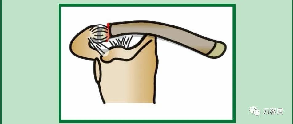 儿童锁骨骨折保守治疗的弊端,锁骨粉碎骨折错位不处理会愈合吗