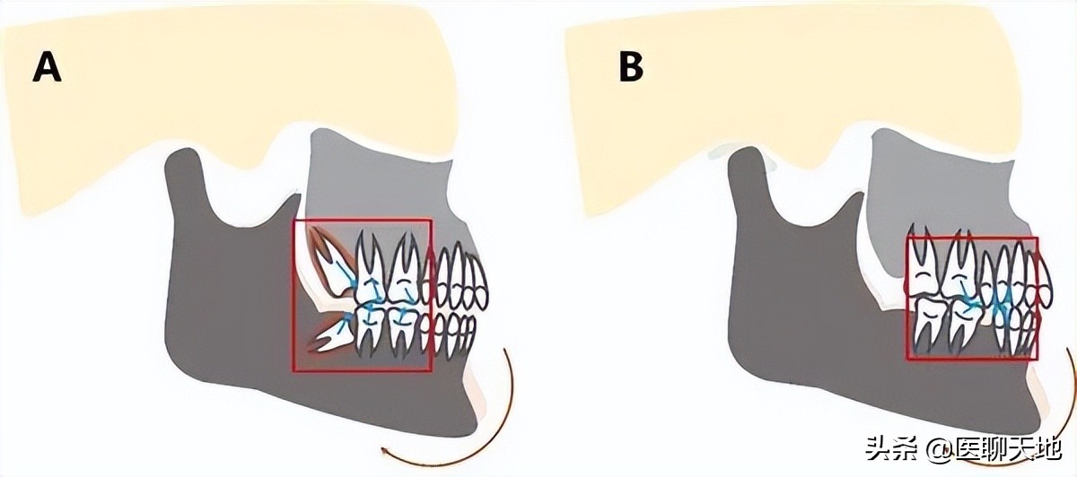 牙齿重复咬到一个地方是什么原因,最近两颗牙齿老咬在一起什么原因