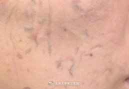 意外留疤怎么安慰,眉尾意外受伤留疤好不好