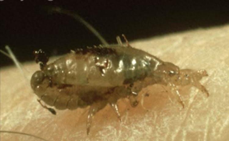 女子体内有蜱虫被医生拿镊子拔出,女子身上长虫医生拿镊子治疗