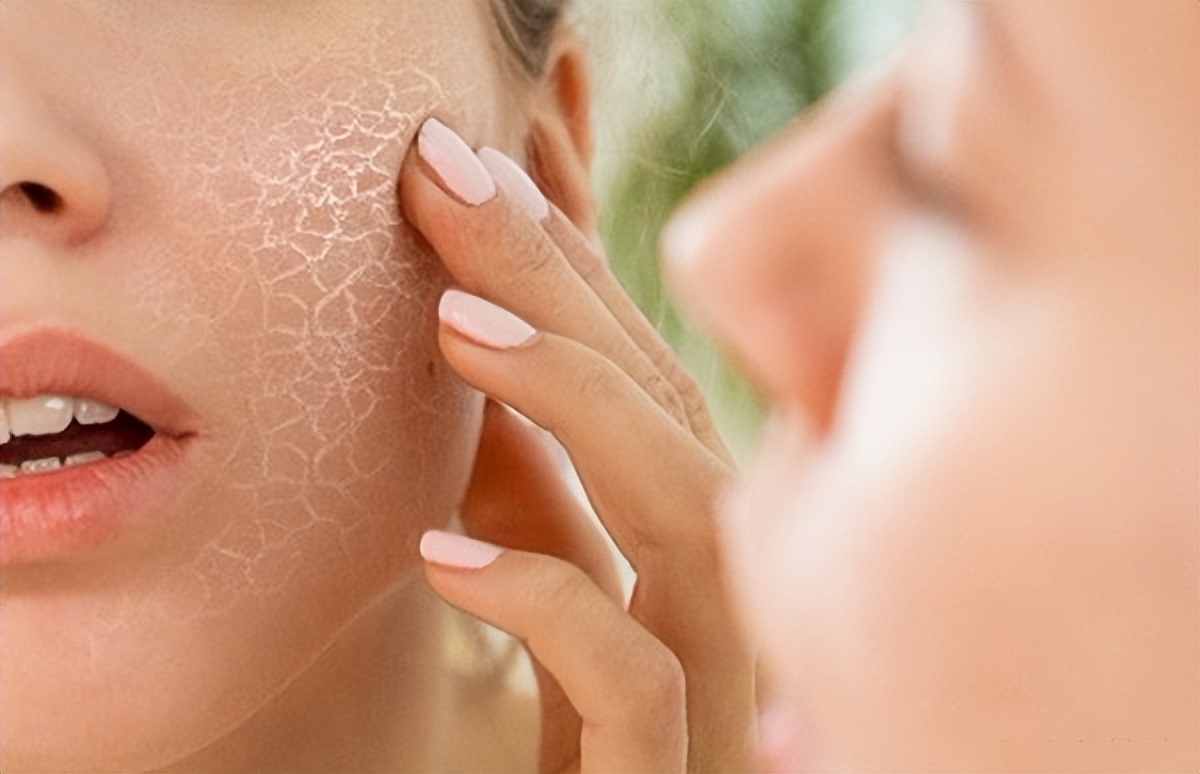 干燥综合征有几种类型,干燥综合征特征性表现