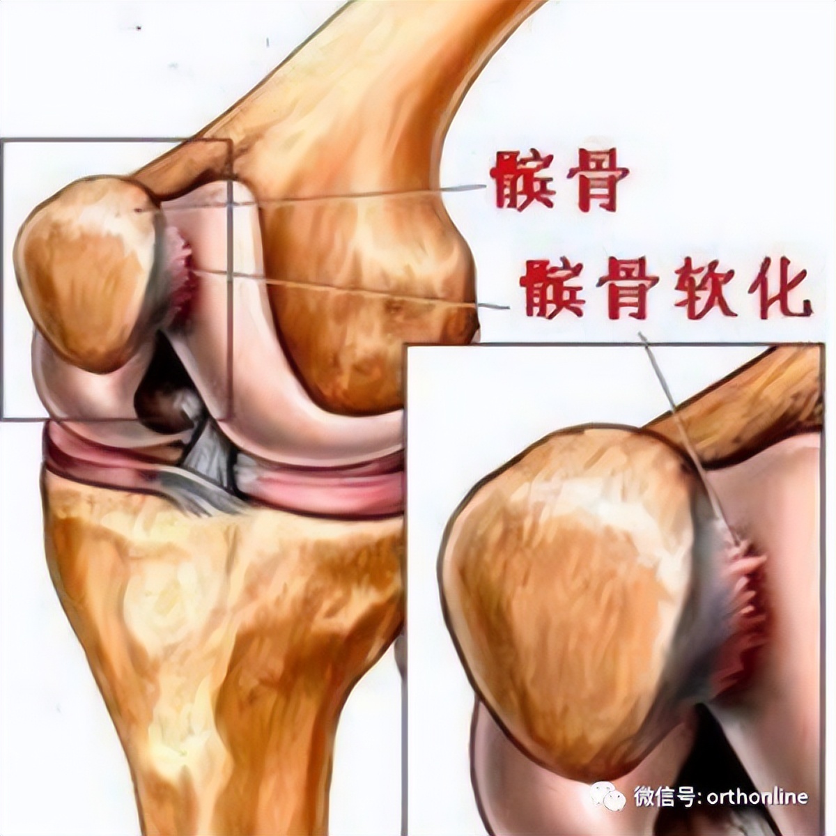 髌骨软化症的最佳疗法是什么,髌骨软化症治疗方法以及康复训练
