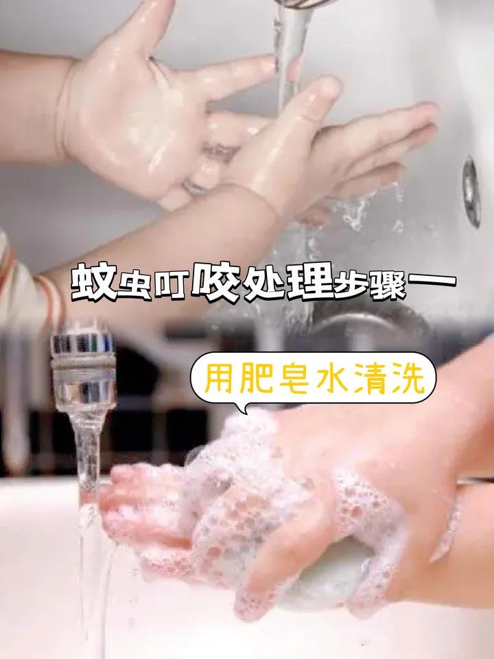 宝宝被蚊虫叮咬后有什么好办法吗,孩子被蚊虫叮咬了生活小妙招