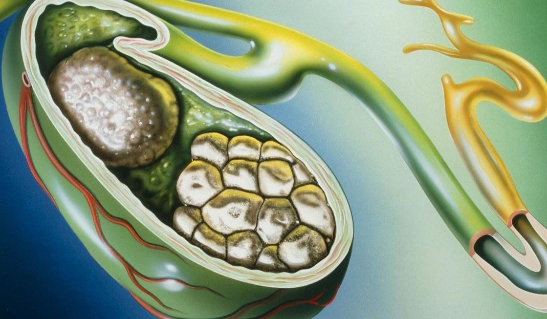 腹腔镜下胆总管切开取石治疗,充填型胆囊结石用腹腔镜怎样切除