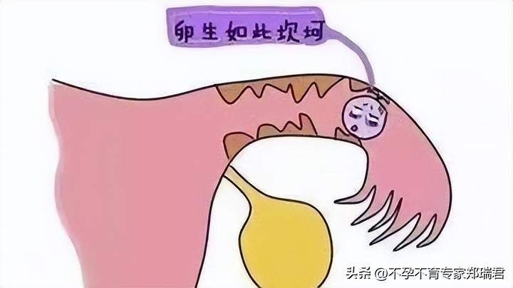 输卵管堵塞只能做试管吗？有没有别的办法？