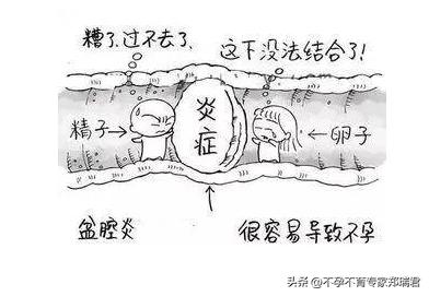 多囊卵巢综合征要注意这四件事情,多囊卵巢综合征的七大征兆