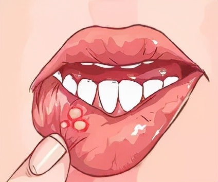 孩子口腔溃疡怎么办如何治疗,儿童口腔溃疡怎么办最快解决方式