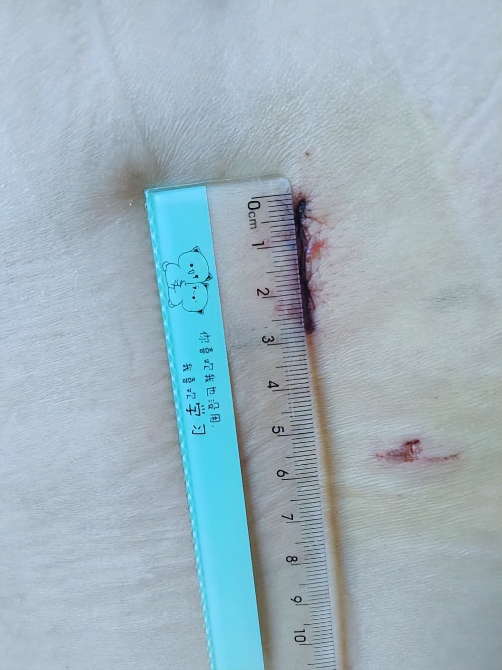 山东医专第一附属医院专栏报道㉑|小切口解决腰椎大问题！术后第二天便可下床活动