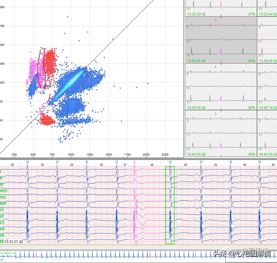 房早与房室交界性早搏心电图鉴别,偶发室早与阵发室早的区别