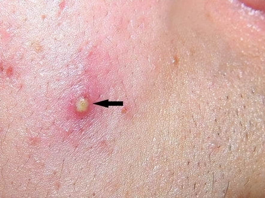 一瓶“甲硝唑”几块钱，或能帮你摆脱5种“疾病”，早了解一下