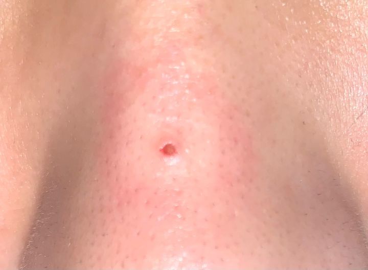 黑头没挤干净怎么办,黑头没及时处理变成黑痣了怎么办