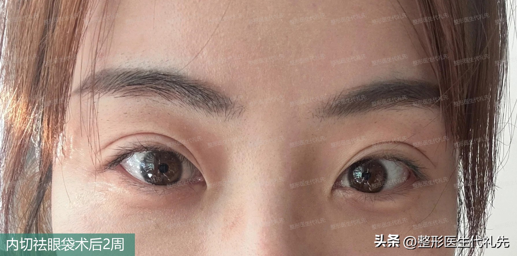 内切眼袋后1-5天恢复图,内切眼袋恢复后对比图片