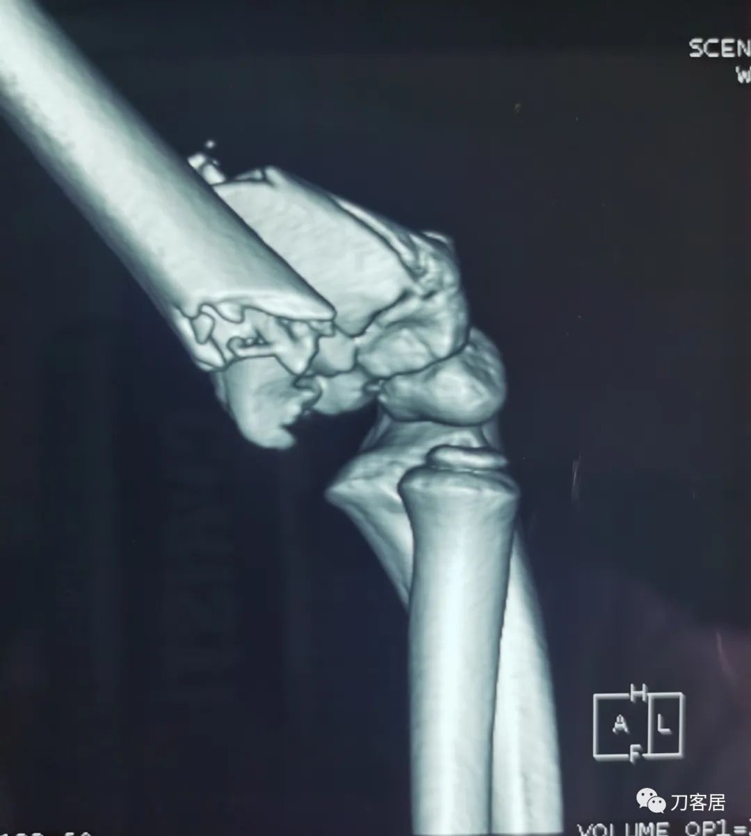 孩子胳膊摔伤肿了不能弯曲一直疼,9岁男孩摔倒手臂痛怎么办