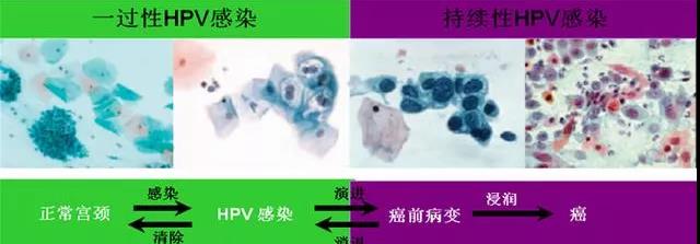 感染hpv会传染给父母吗,感染hpv会传染给别人么