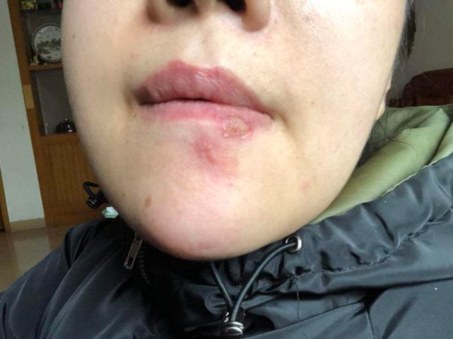 嘴巴边缘长水泡是上火了吗,嘴唇上火长水泡最简单的解决方法