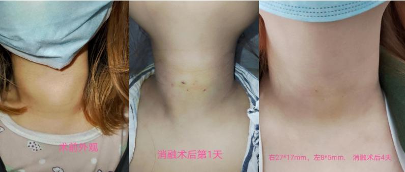 甲状腺囊实性结节微波消融好吗,甲状腺良性结节微波消融术优缺点