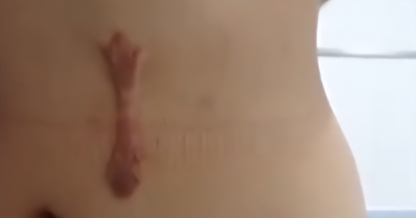 女孩单位体检时少一个肾最后结果,入职体检查出少个肾