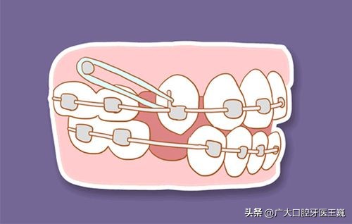 矫正牙齿戴牙套感觉疼痛怎么缓解,牙齿矫正戴牙套牙疼怎么解决