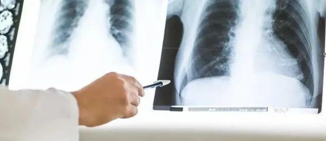 干细胞变身“修复师”，对抗肺部疾病