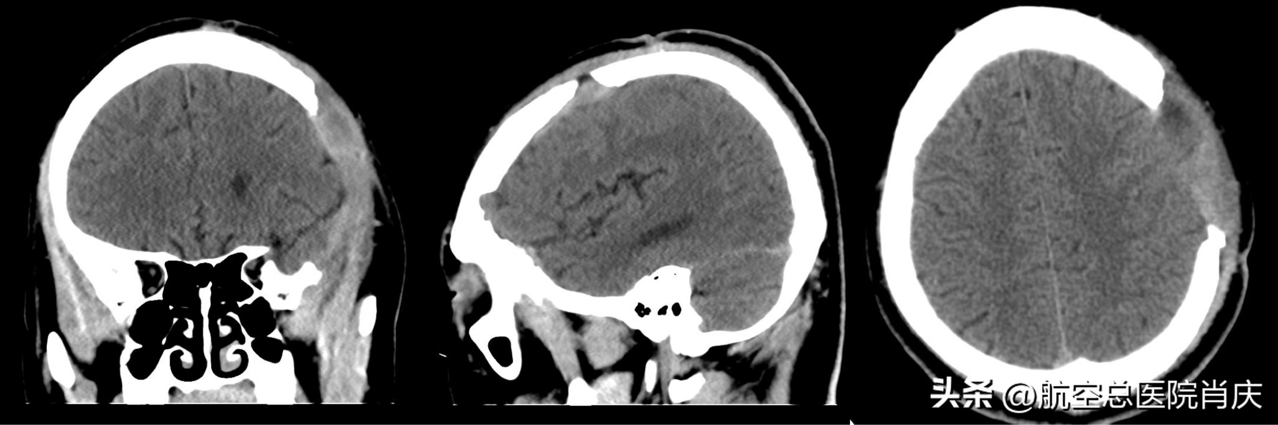 脑外伤开颅手术高烧是怎么回事,脑外伤昏迷病人苏醒恢复意识