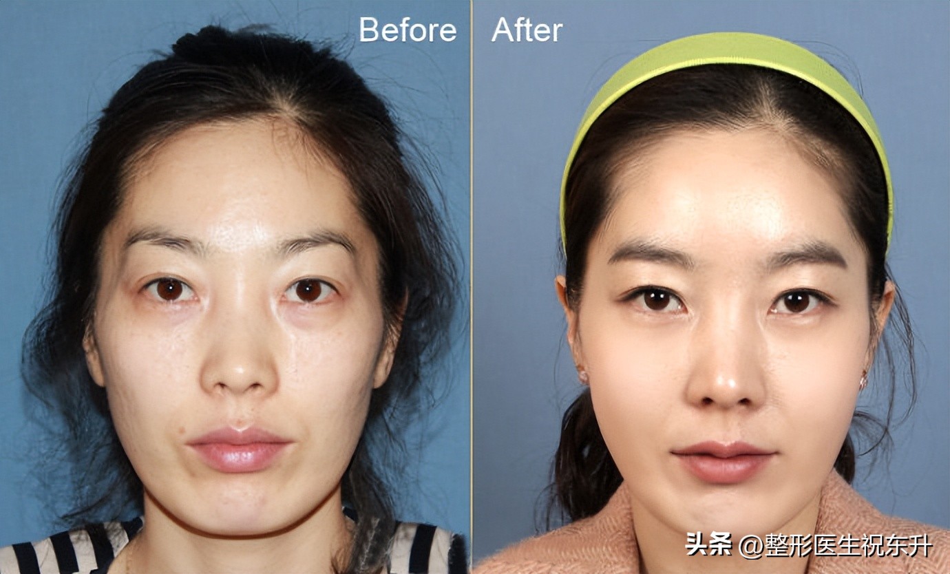 想变漂亮做什么医美,想变漂亮也不要犹豫