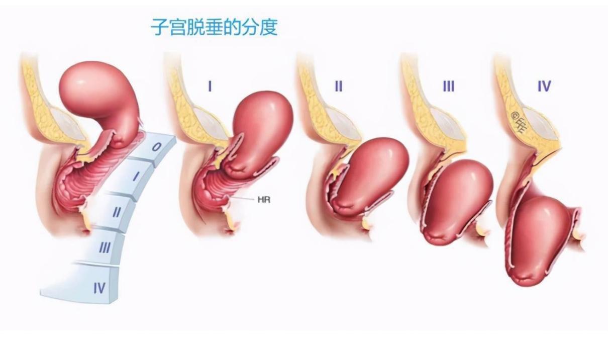 子宫里掉出小肉球,子宫内壁有肉突出来