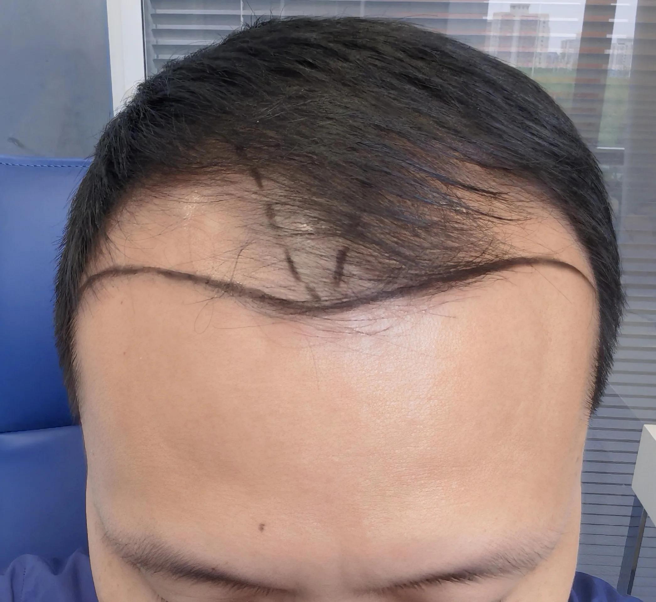 植发的亲身经历和感受,植发1000毛囊真实经历视频