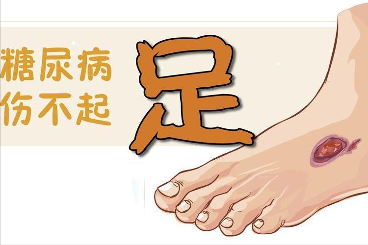 糖尿病足如何才能避免截肢,糖尿病足什么样的需要截肢