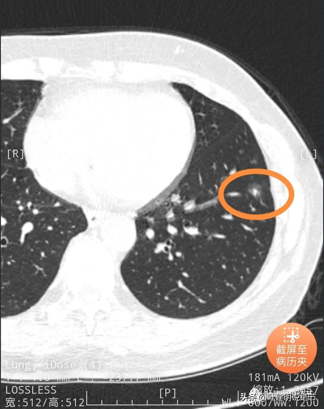 辽宁省肺结节手术哪家医院好,辽宁肺结节手术医院