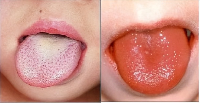 6岁小孩浑身长鸡皮疙瘩,6岁小孩发烧浑身起鸡皮疙瘩