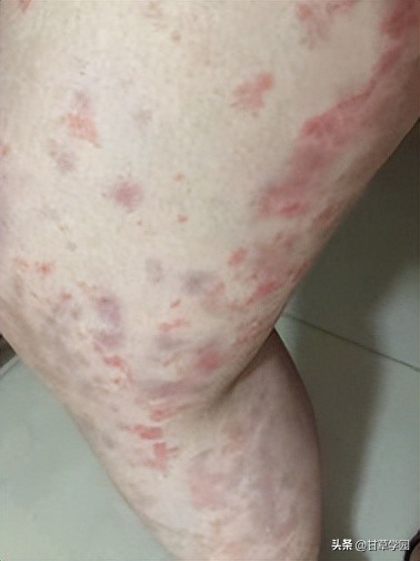 薯蓣丸治疗荨麻疹,柴胡桂枝干姜汤治疗荨麻疹