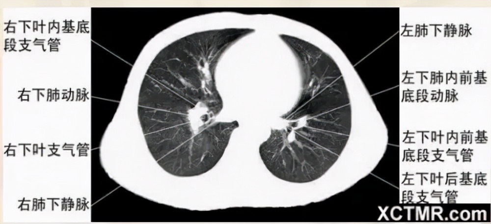 胸腹部盆腔ct主要检查什么,女性盆腔ct断层解剖结构图