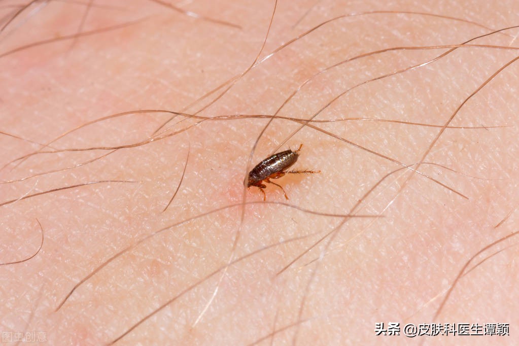 丘疹性荨麻疹皮炎有哪些忌口,丘疹性荨麻疹止痒小妙招是什么