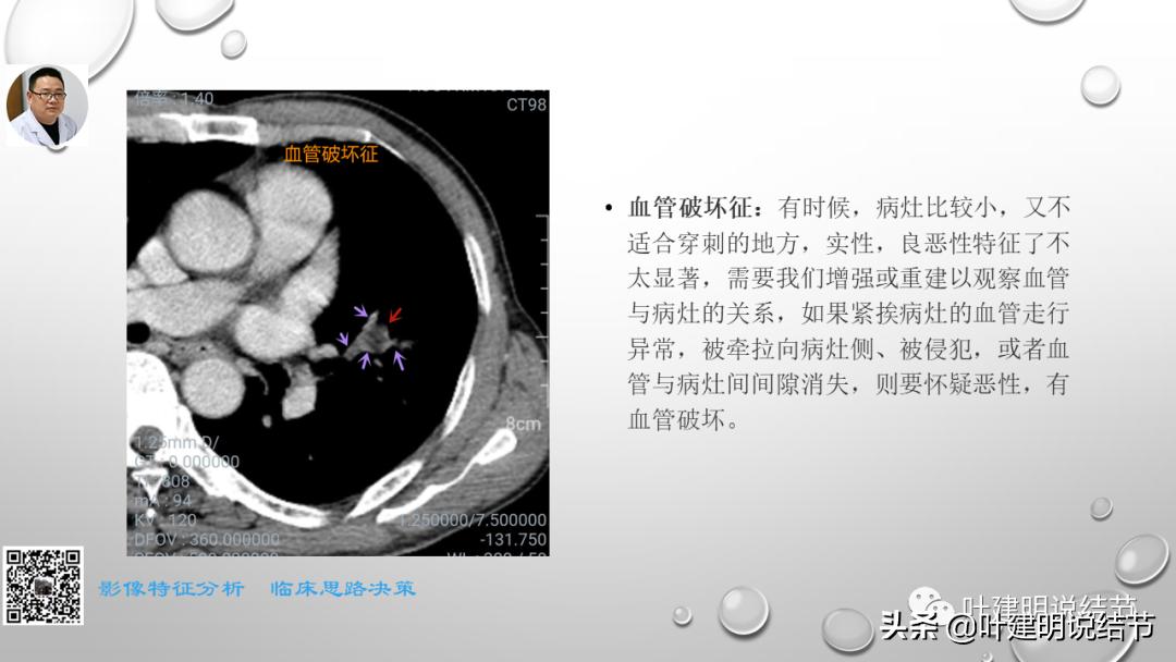 在《一脉阳光》呼吸影像诊断专题培训班上的讲课PPT（第一部分）