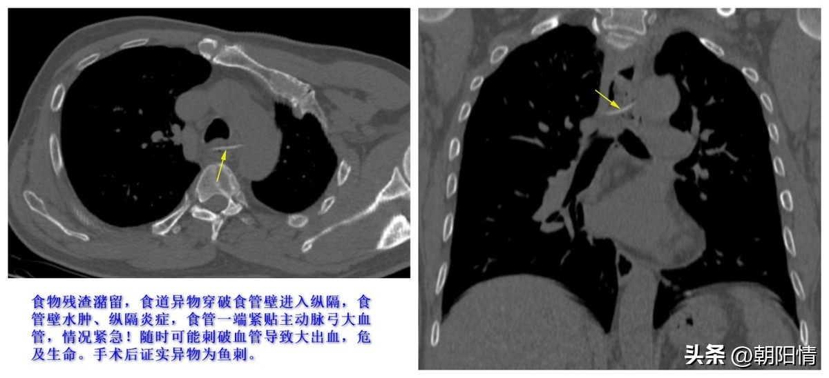 消化道异物中医诊断名称,消化道骨性异物